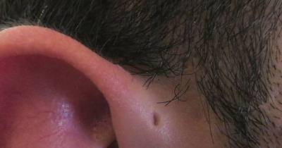 Some People Have Tiny Holes Above Their Ears And There Is A Good Reason Behind It