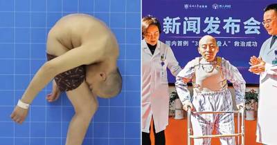 Man Born Folded Half Leaves Hospital Standing Straight After 28 Years