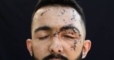 Victims From Beirut Blast Show Off Their Scars To Tell The World The Trauma They Went Through