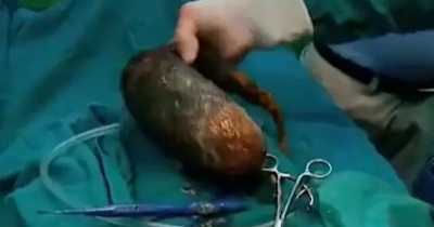 Doctors Remove Massive 15lb Hairball From Teenager's Abdomen