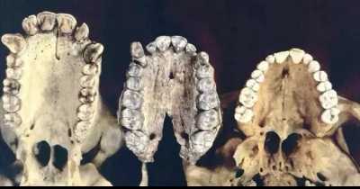 "Rapid Evolution" Means Human Babies Now Being Born Without Wisdom Teeth