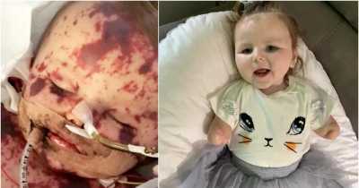 Doctors Warned Parents Their Little Girl Wouldn&rsquo;t Survive &lsquo;Worst Case Of Meningitis&rsquo;- It Stole Her Limbs But Now Two Years Later She&rsquo;s All Set To Start School