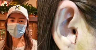 Woman Demands Refund After Doctors Removed A Part Of Her Ear During Nose Job Surgery Without Her Knowledge