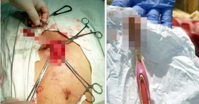 This Bloodied 19cm Long Toothbrush Was Removed From A Man's Stomach After He Accidentally Swallowed It
