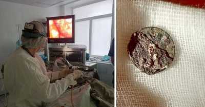 Coin Stuck In A Man's Nose For More Than 50 Years Until He Had A Breathing Issue