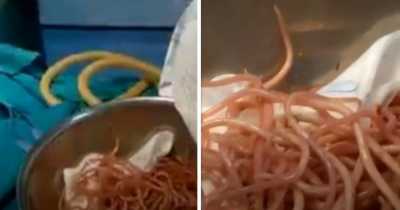 World's Worst Tummy Ache: Over A Hundred Parasitic Worms In Man's Stomach Were Removed
