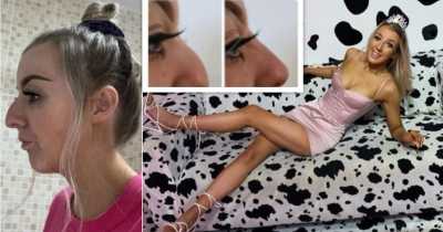 21-Year-Old Girl Decided To Have Fillers After Abusive Boyfriend Called Her &lsquo;Ugly B***h&rsquo; And Said It Was &lsquo;Embarrassing&rsquo; To Go Out With Her Because Of Her Nose