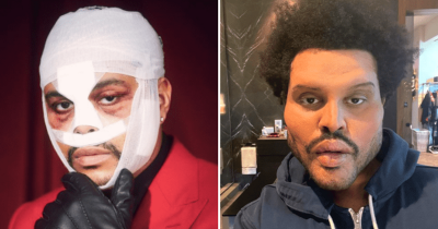 Weeknd's Plastic Surgery Look Leaves Fans Horrified