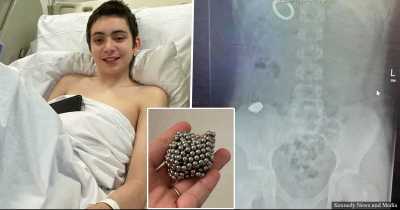 Boy Swallows 54 Magnets To Become Magnetic, Undergoes 6 Hour Life-saving Surgery
