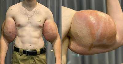 Real-Life Russian Popeye Undergoes Surgery To Remove Hardened Jelly From Fake Muscles