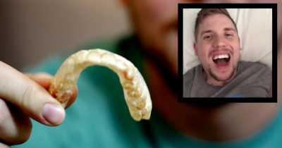 Guy Didn't Know He Could Take Out His Retainers, Removes Them For The First Time In Five Years