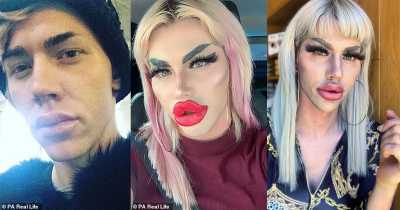 A Male Tech Expert Got Filler Worth $15,000 To Get The &lsquo;Plastic Doll-like Look&rsquo;