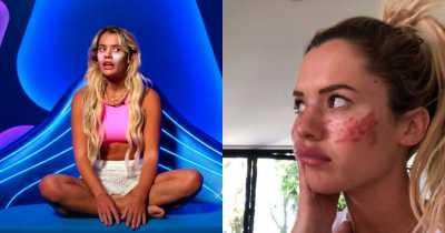 Influencer Tilly Whitfield Says She Lost Vision After Trying Viral Tiktok Freckles Hack.