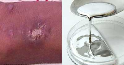Teenager Injected Himself With Mercury Atleast Three Times To Be Like X-Men Superhero
