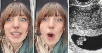 Woman Finds Ovarian Cyst Having 'Teeth And Hair' Growing In Uterus For 2 Years