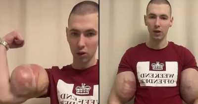 Man Dubbed 'Russian Popeye' Flexes Huge Jelly Injected Arms Sparking Concern