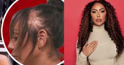 Sophie Kasaei Has Opened Up About Her Battle With Traction Alopecia.