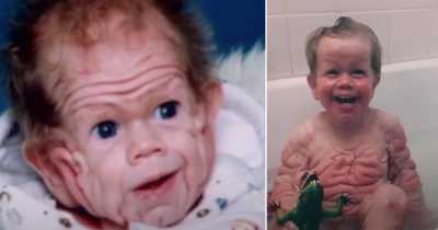 Tomm Tennent: Unique Baby Born With Enough Skin To Cover The Body Of A Five-Year-Old Child