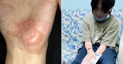 Texas Middle School Students Suffer From Severe Hand Burns Due To Gym Teacher's Inhumane Punishment