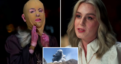 Woman Who Survived White Island Volcano Eruption Removes Face Mask
