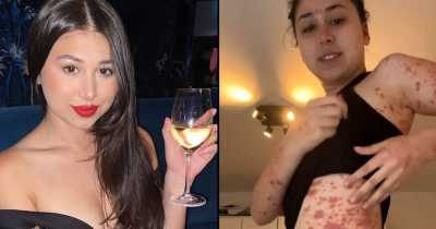 Woman Says Sharing Vape With Friends At University Triggered 'Red Raw Skin Condition'