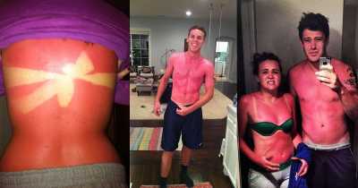 Some Of The Worst Sunburns On The Internet