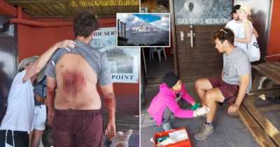 Tourist Falls Into Mount Vesuvius While Taking Selfie, Shows His Injuries