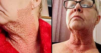 Horrified Woman Left &lsquo;Looking Like A Lizard&rsquo; After A Botched Skin Tightening Procedure