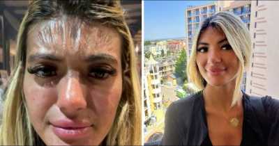 Woman Who Fell Asleep In Sun For 30 Minutes Wakes Up With A 'Plastic Forehead'