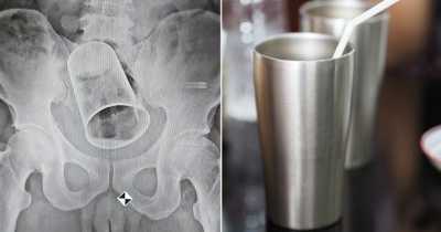 Doctors Remove A Steel Cup From A Man&rsquo;s Rectum In India