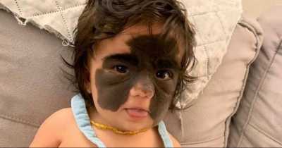 Two-Year-Old Girl Has &lsquo;Batman&rsquo; Birthmark Removed In Pioneering Surgery