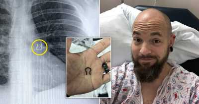 'I Lost My Nose Ring And Found It 5 Years Later &mdash; In My Lung'