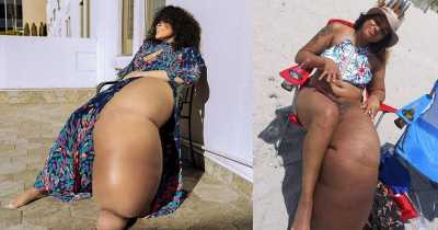 'People Troll Me For My 7 Stone Leg, But I&rsquo;m Proud Of My Body'