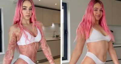 Woman Says She Managed To Clear Psoriasis Covering 90% Of Body After Discovering The Root Cause