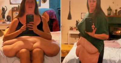 Woman Who Lost 26st To 'Save Her Own Life' Shares Video Of Excess Skin Before Operation