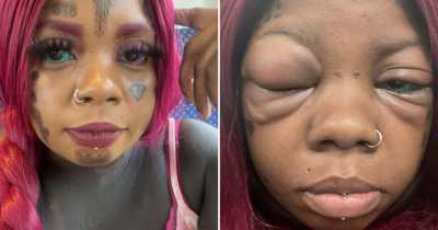 Mother Going Blind After Tattooing Her Eyeballs Blue And Purple To Copy An Influencer