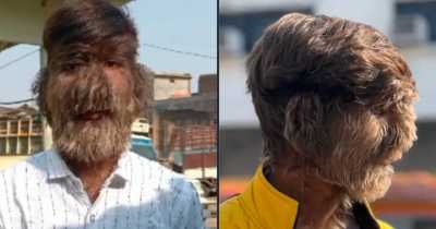 Teenager With Werewolf Syndrome  Was Covered In Hair Immediately After Being Born