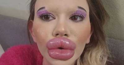 Woman With World's Biggest Lips Wants Them Even Larger With More Fillers