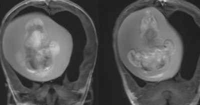 Doctors Remove Fetus Of 'Parasitic Unborn Twin' From One-Year-Old Sister's Skull