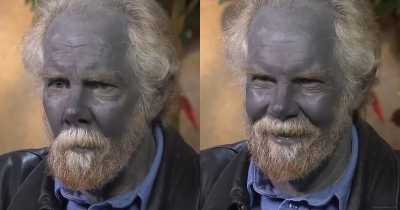 Man Turned Completely Blue After Taking Dietary Supplements For Years