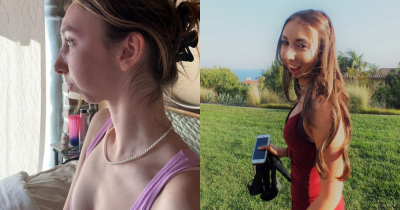 Women Bullied For 'Looking Like Squirrel' Spent $200K On Surgery