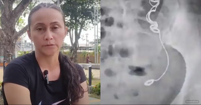 Mar&iacute;a Forero Endured Excruciating Pain For 11 Years Before An MRI Scan Revealed She Had Needle And Thread Stuck Inside Her