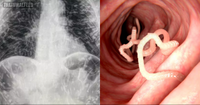 Man Who Went To Hospital With Cough Shocked To Discover He&rsquo;s Swarming With Tapeworms