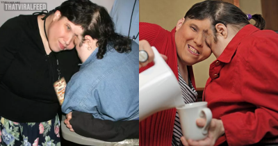 Conjoined Twin Explains What Happens During Sister's Intimate Moments With Boyfriends