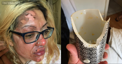 TikTok Poached Egg Hack Leaves Mother In Absolute Agony With Burns All Over Face