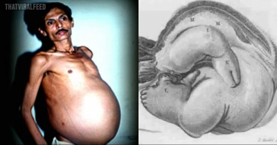 The Story Of A Man Who Carried Twin Inside Him For 36 Years Without Knowing