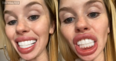 Woman Goes Viral For Her Veneers That Made Her Look Like A Horse