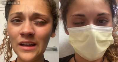 Woman Ends Up In Hospital After Accidentally Using Super Glue Instead Of Eye Drops