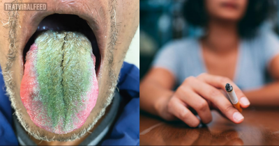 Man's Tongue Sprouts Green Hair After Years Of Smoking Cigarettes