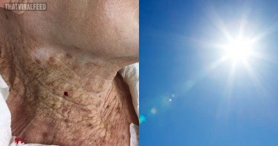 Striking Picture Shows Consequences Of 92-Year-Old Woman Using Sun Cream On Her Face But Not Her Neck For Decades